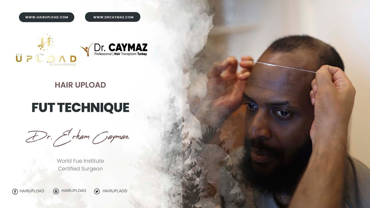 Fut Technique - Hair Transplant Turkey