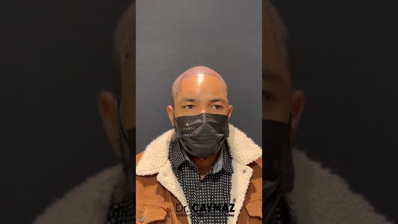 Mr Leonardo   USA   4000 Graft   Afro American Hair Transplant 