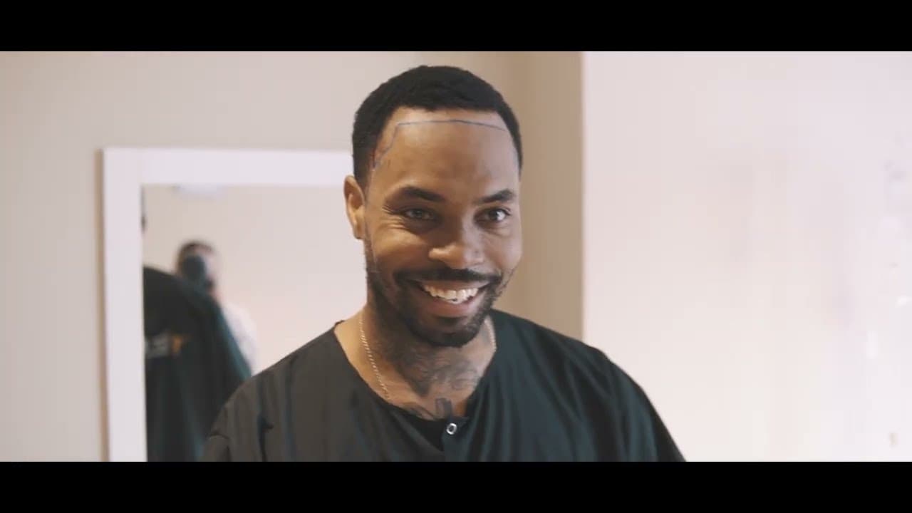 Best Hair Transplant Doctor in Turkey with _Kingtrell & Stet2.0