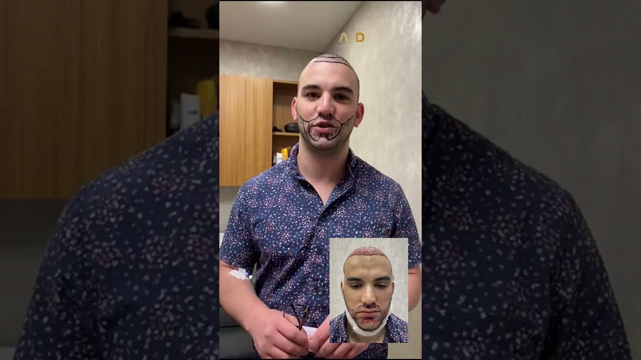 Mr Damian - USA - Review about Dr Caymaz Hair Upload Clinic