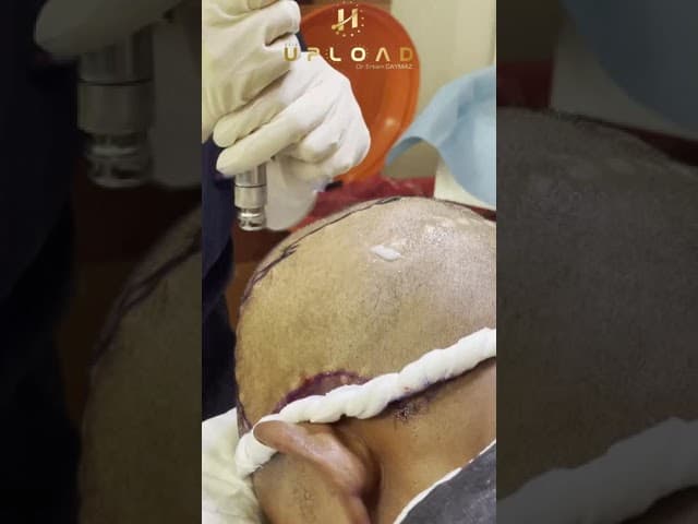 PAINLESS ANESTHESIA DEVICE