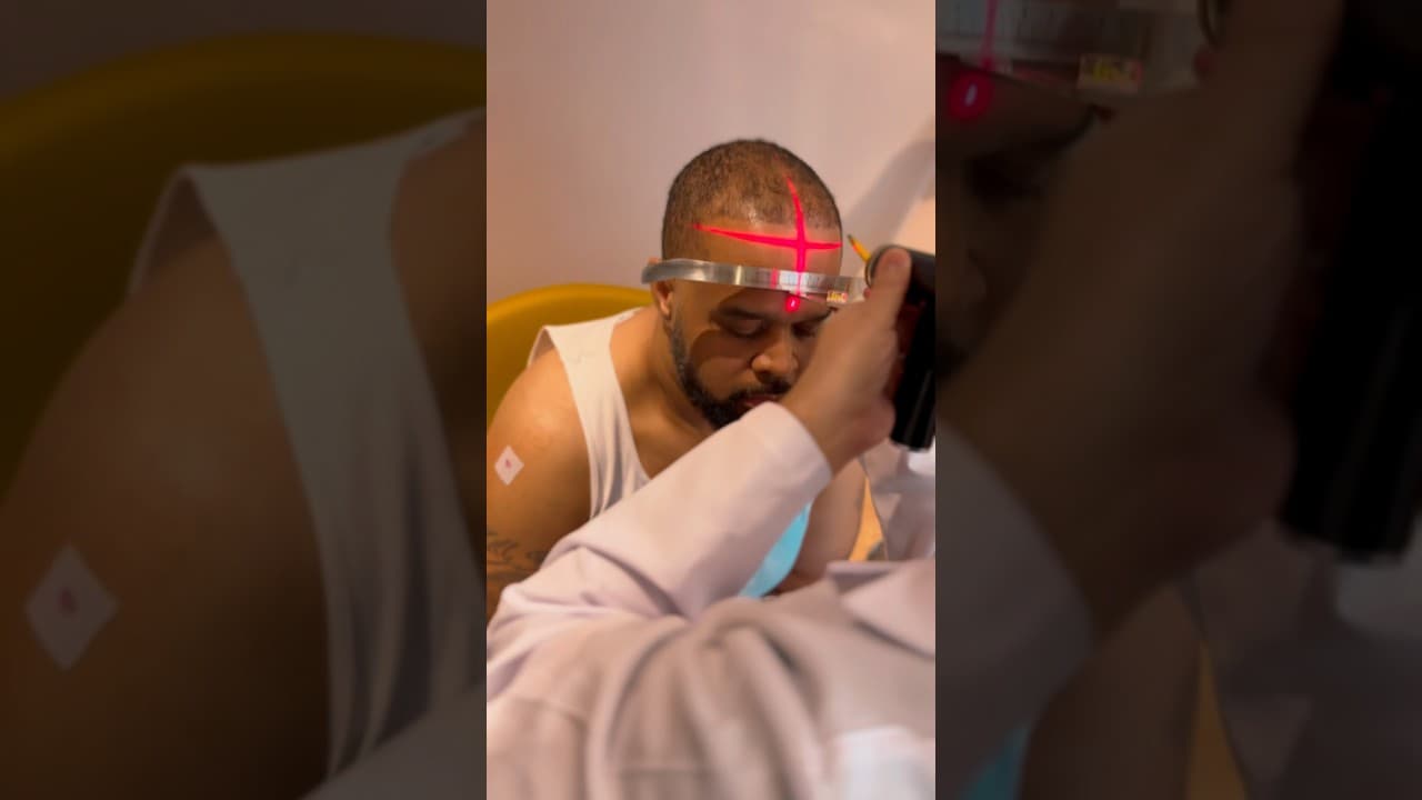 Afro Hair Transplantation