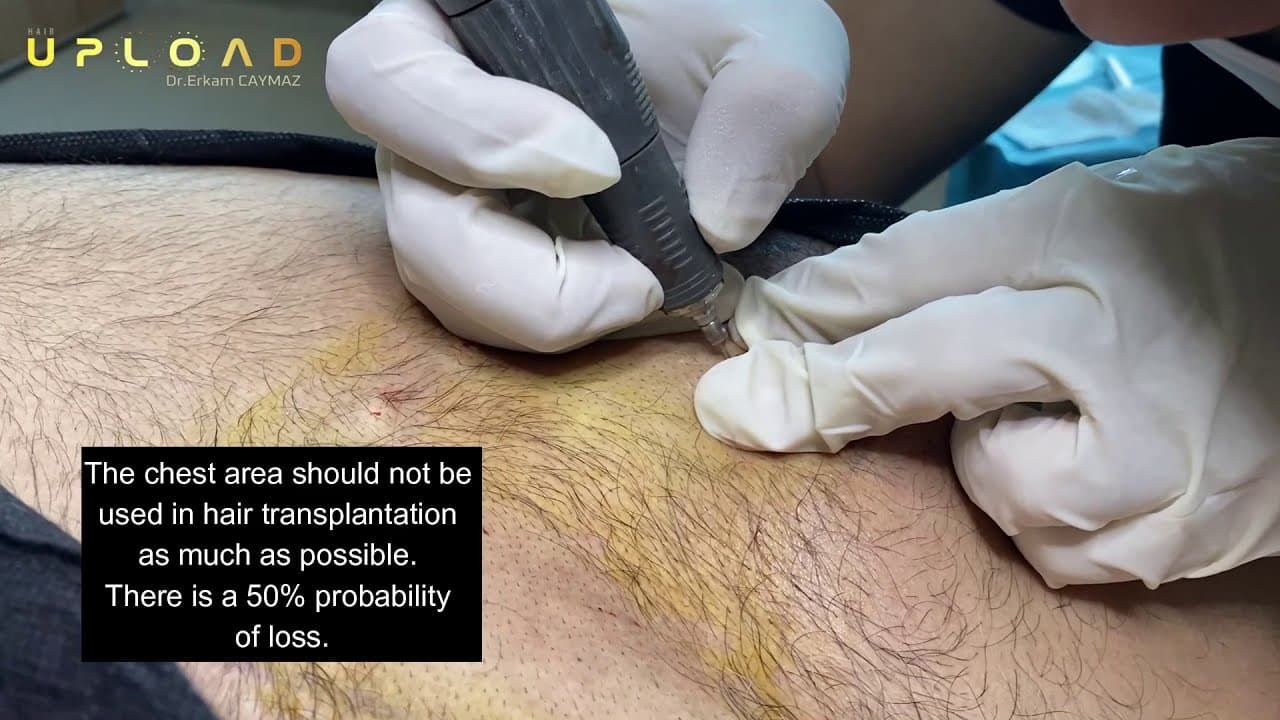 Chest Donor Area   Body Hair Transplant