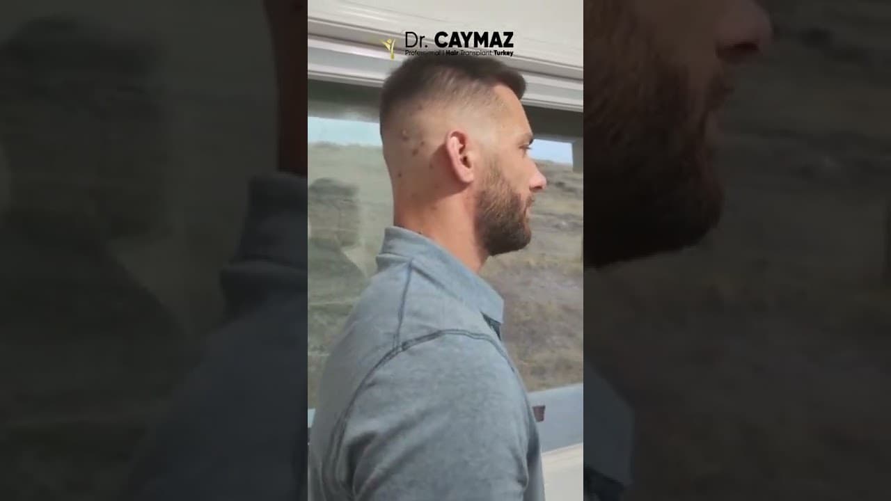 Mr Markus   7 Months   DHI   3000 Graft