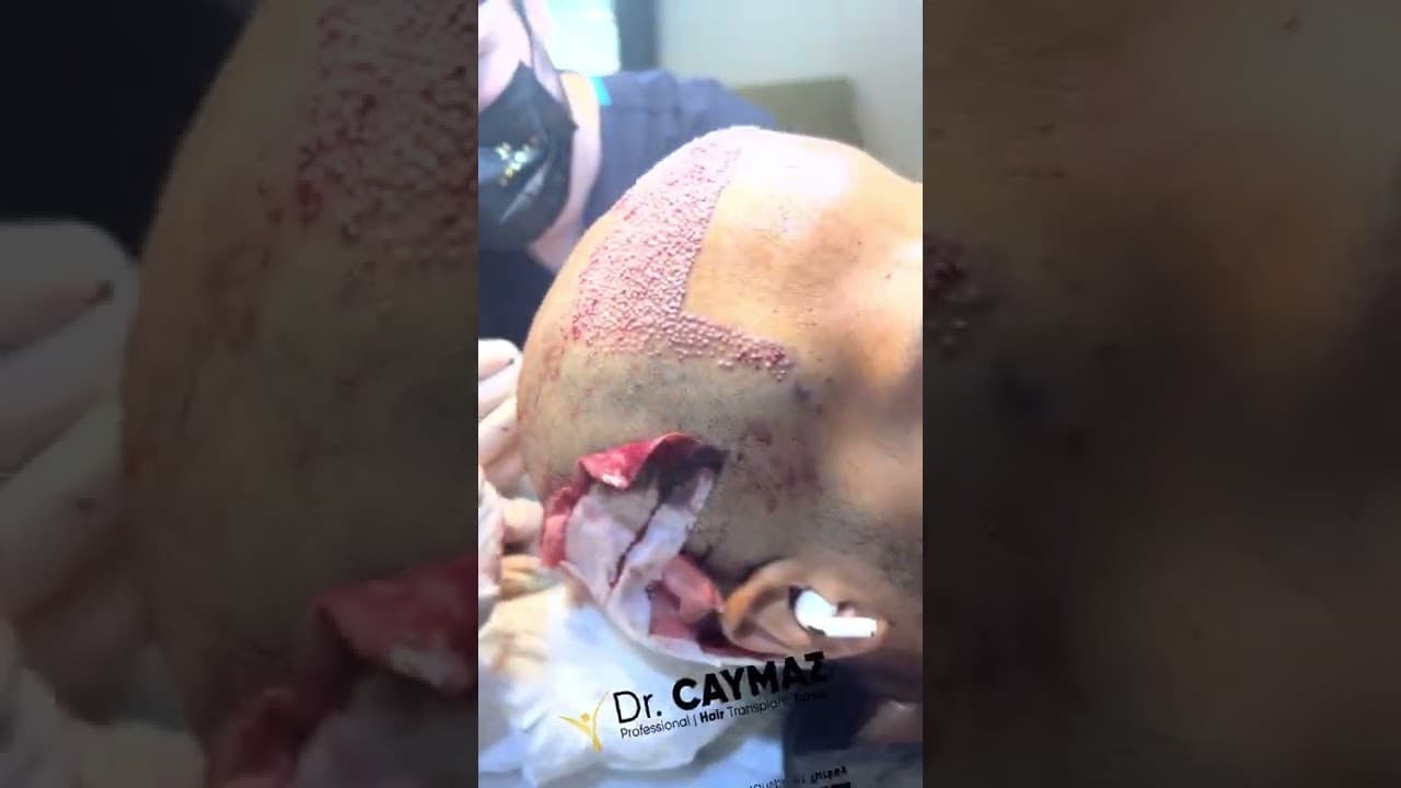 Best Hair Transplant Turkey