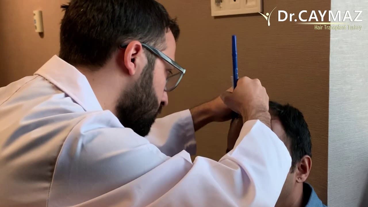 Consultation and Hair Line Design with Dr.Erkam CAYMAZ