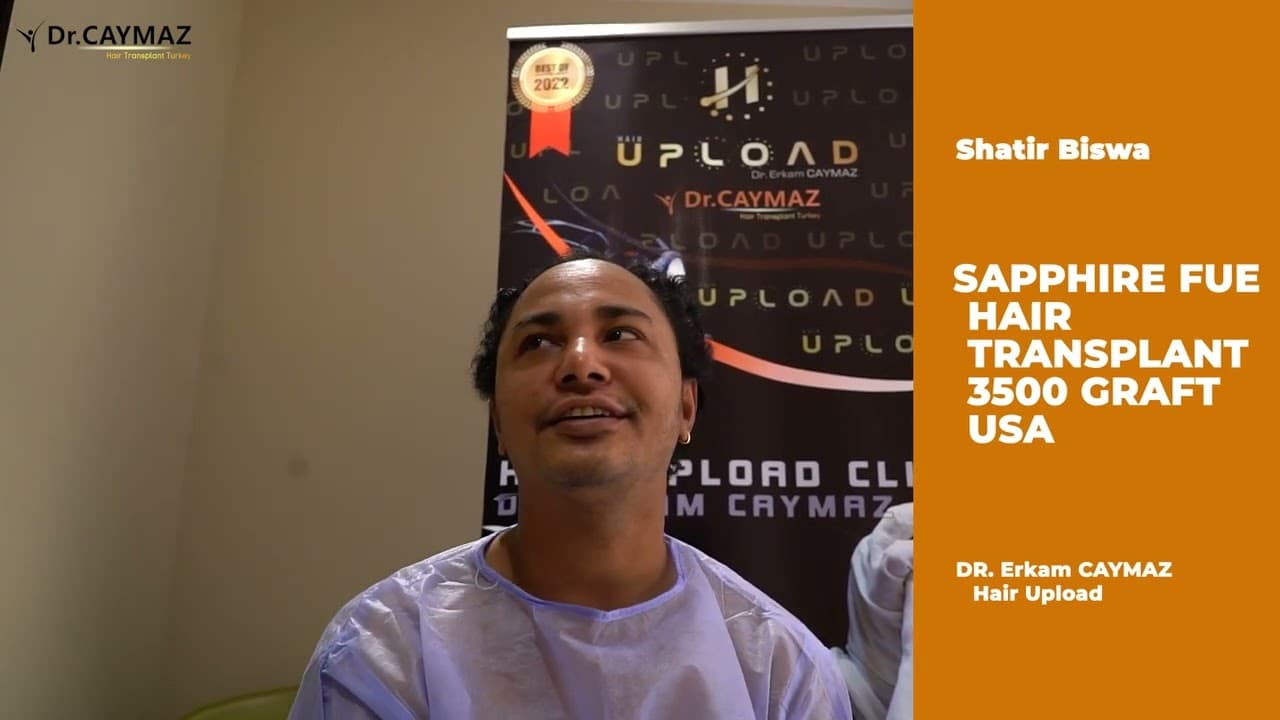 Hair Transplant Review from MR Shatir 1