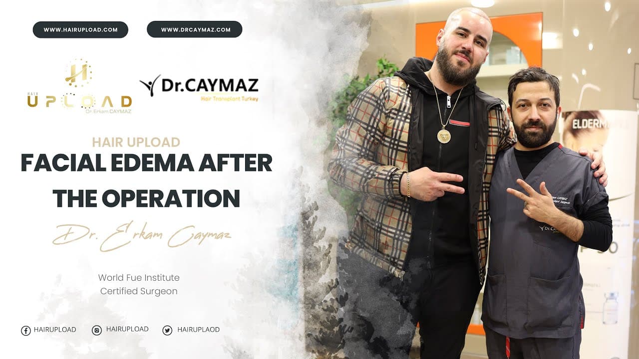 Facial edema after the operation