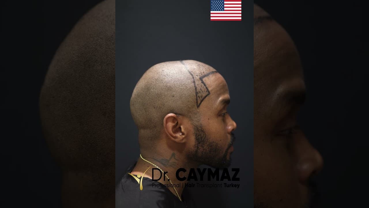 3200 Graft - 6 Months Afro American Hair Transplant Result