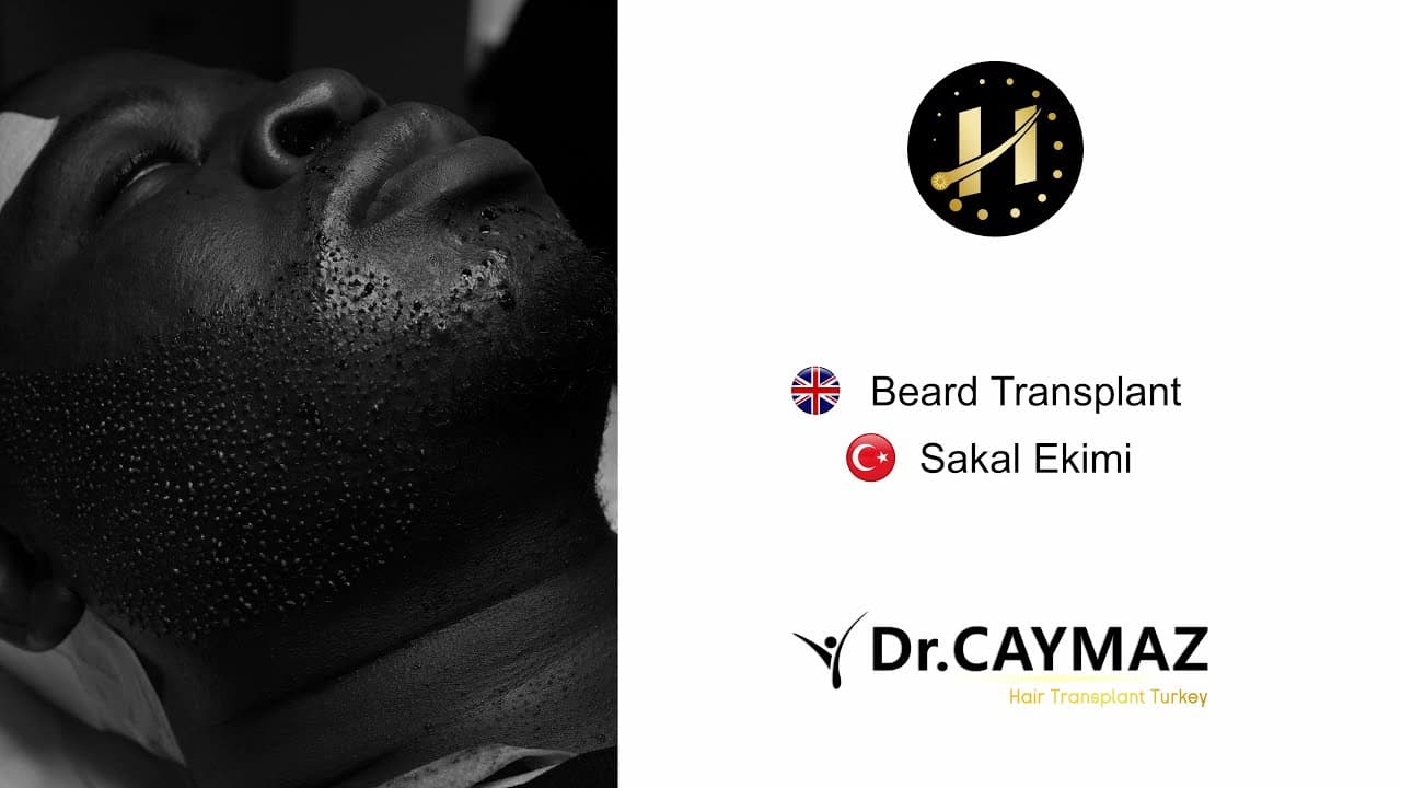 Beard Transplantation