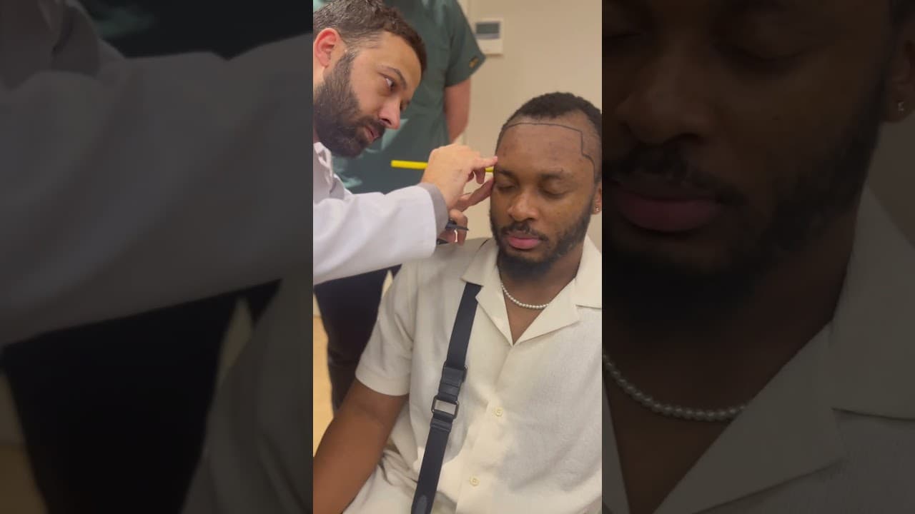 Afro Hairline Design by Dr Caymaz