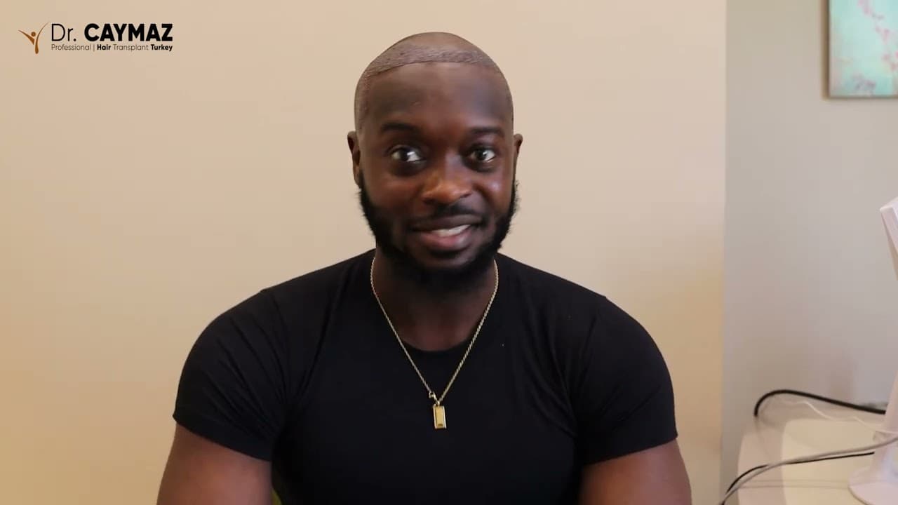 Samuel Abaku Adusei  - USA - 2100 Graft - Afro American Hair Transplant Review - Sapphire FUE