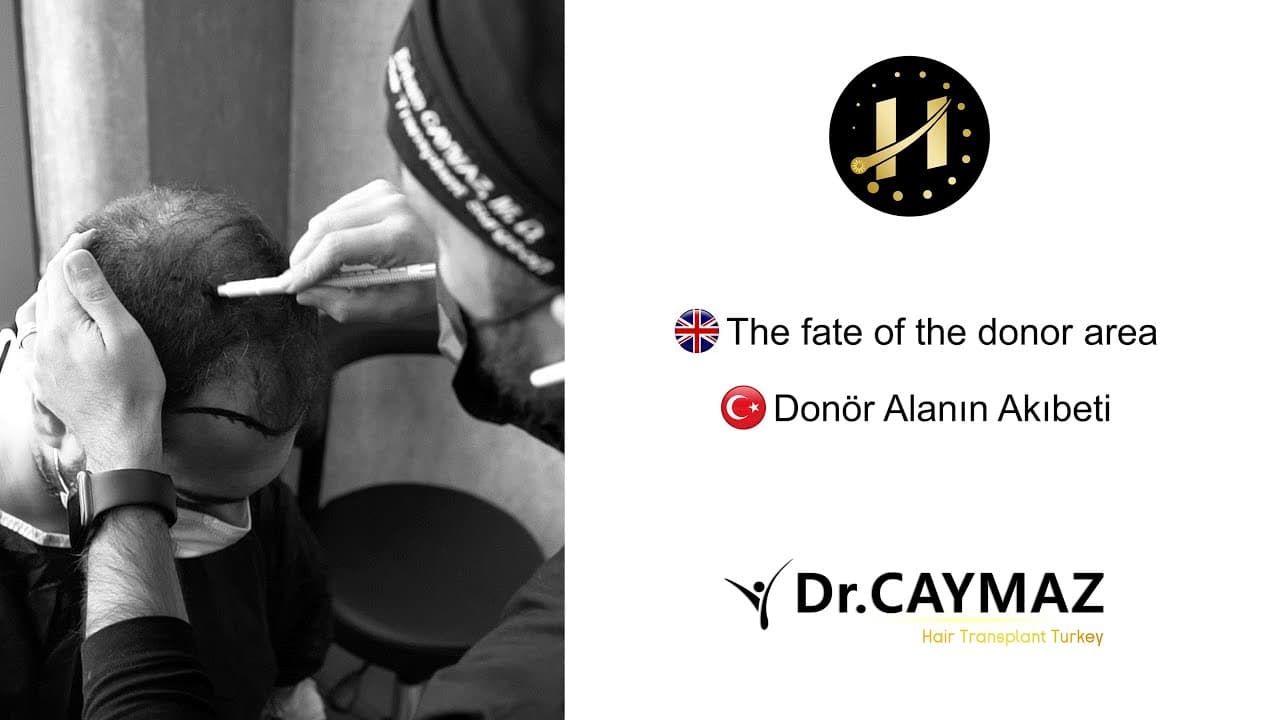 The Fate of the Donor Area - Dr. Caymaz Hair Upload Clinic