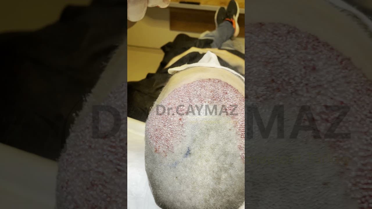 3700 Graft High Density