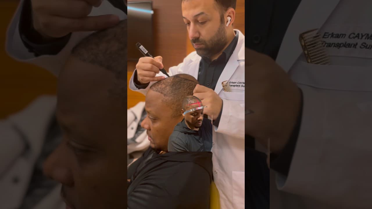 Afro Hairline Creating by Doctor