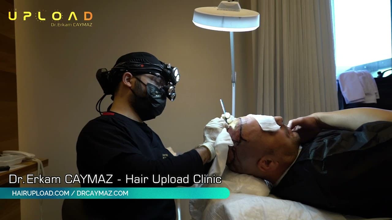 Hair Transplant Turkey - Hair Transplant Process - Hair Upload Clinic