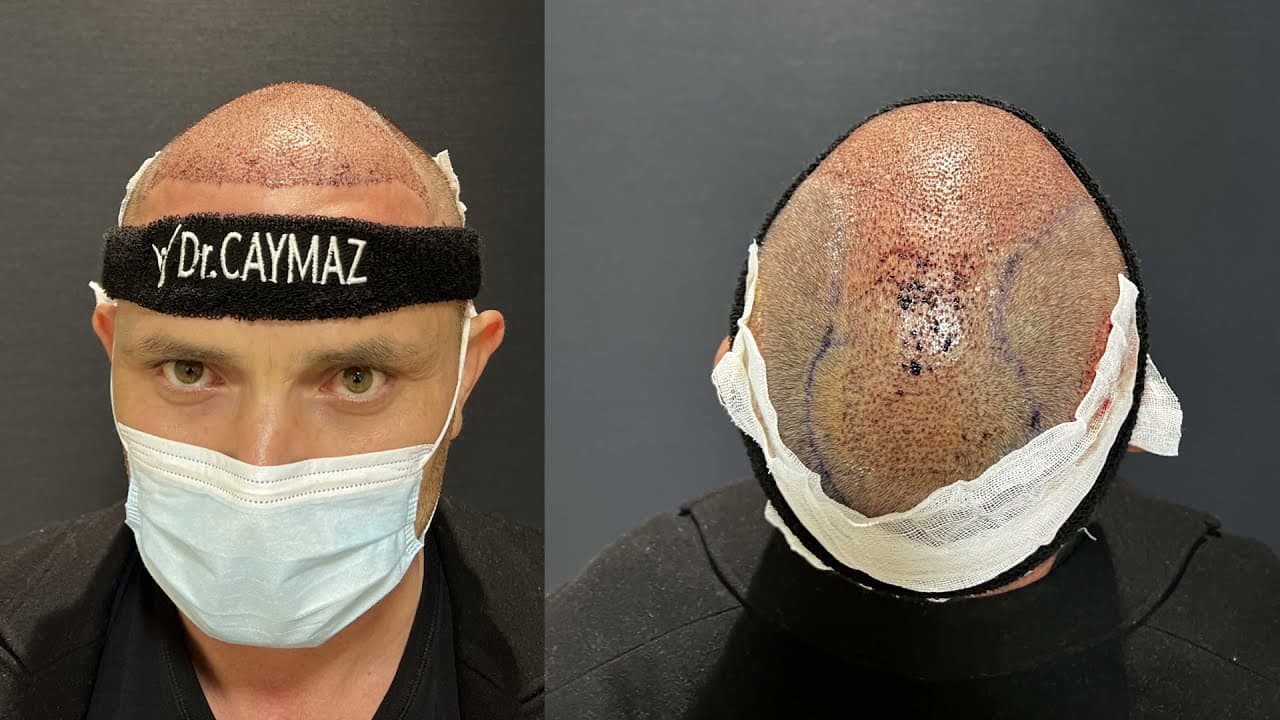 Mr ELVIR - 5250 Graft - USA - Dr Caymaz | Hair Upload