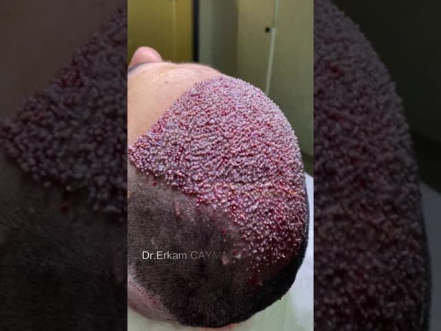 High Density Hair Transplantation in Turkey with Hair Upload Clinic