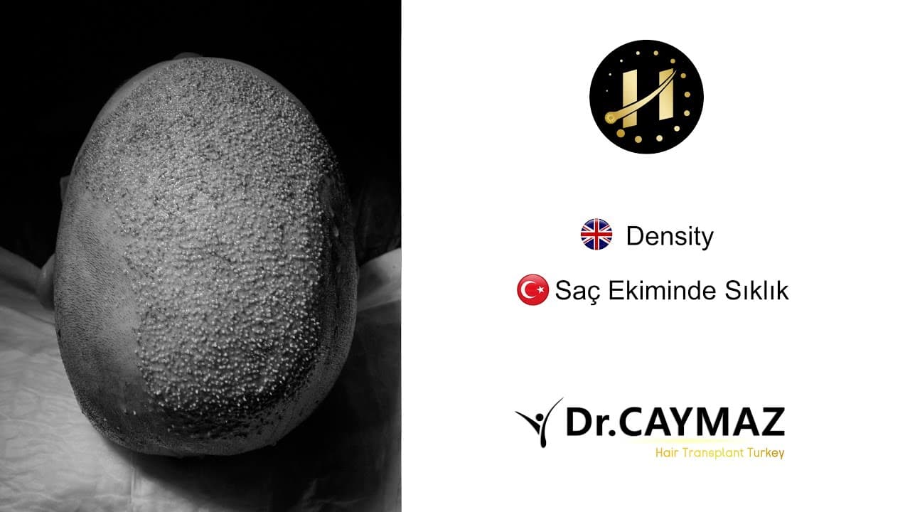 Hair Transplant Density
