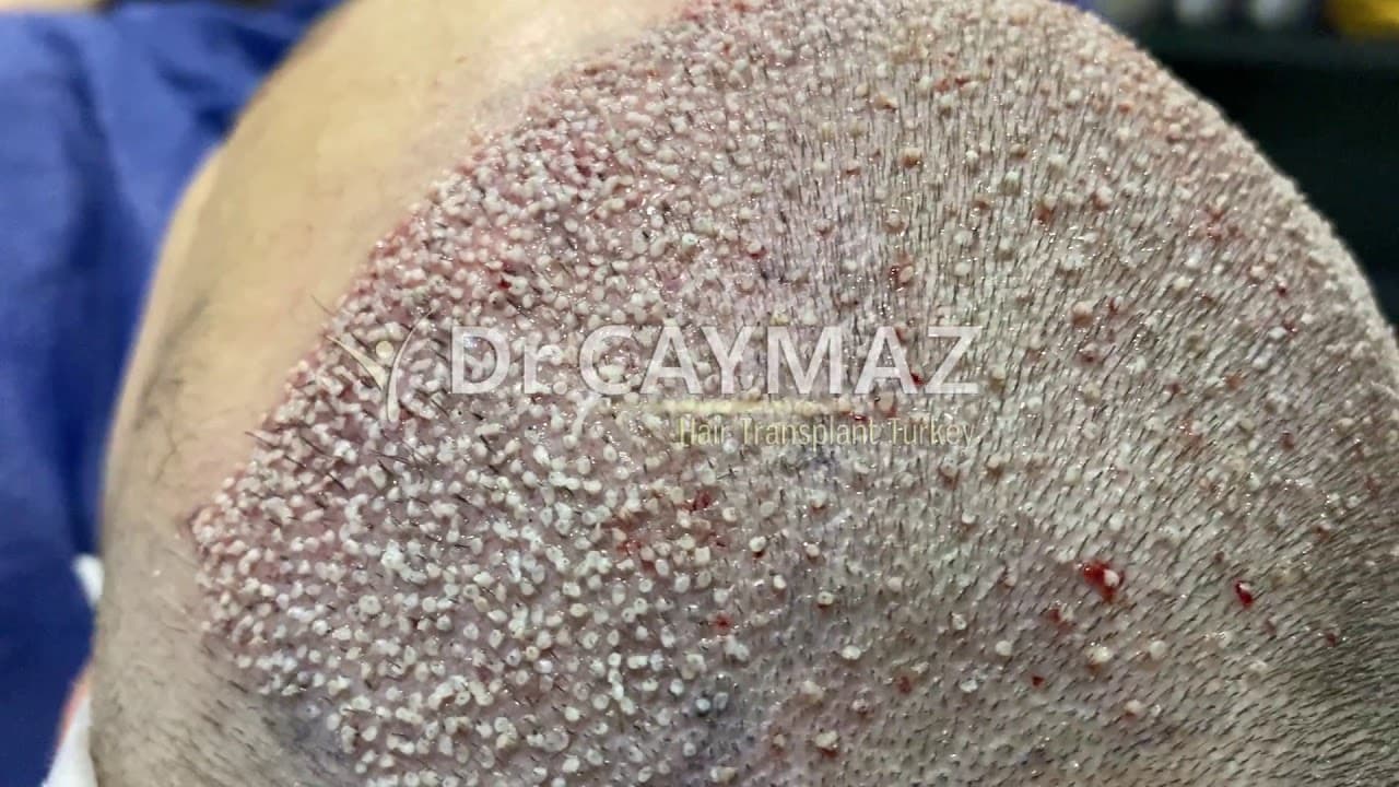 High Density Hair Transplantation in Istanbul / Turkey - Dr.Erkam CAYMAZ
