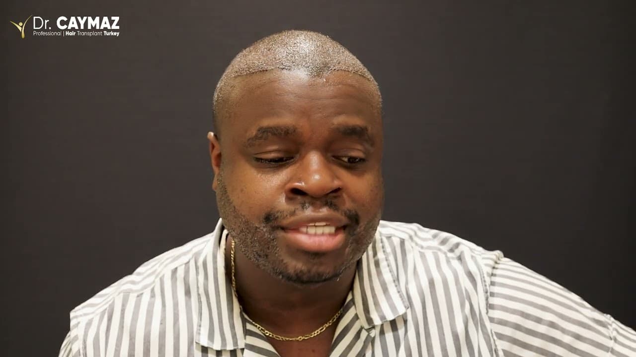 Antonio Mcinnes - USA - 3200 Graft - Afro American Hair Transplant Review - Sapphire FUE