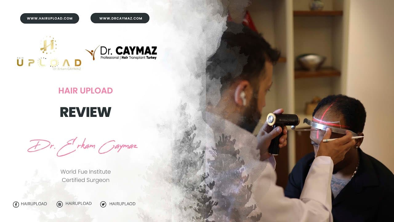 Jean Tsana | Sapphire FUE | 2500 Graft | UK - Hair Transplant