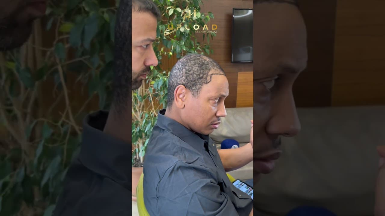 Best Hair Transplant Hairline