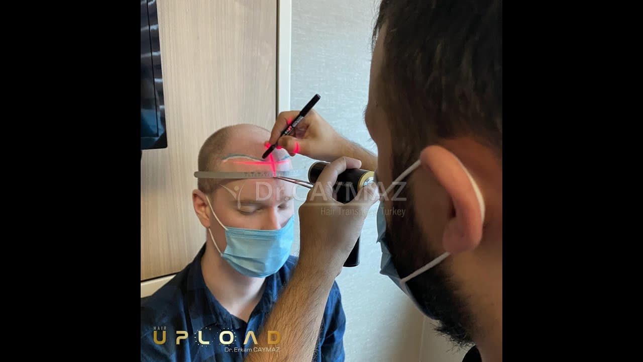 Mr Brandon 5 Months  - 5500 Graft - Sapphire Fue | Dr Erkam CAYMAZ - Hair Transplant Turkey