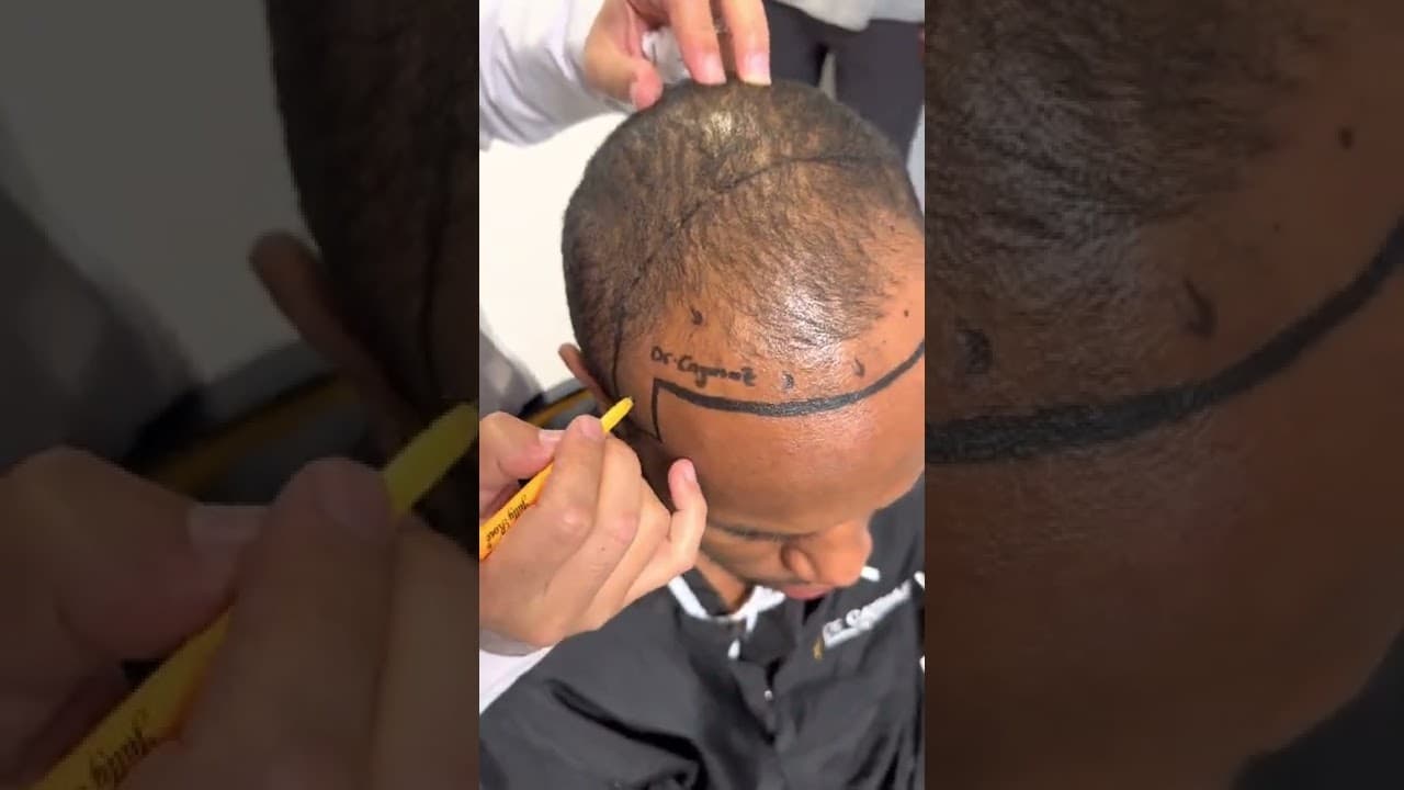 Beard Line Designing by Dr Caymaz