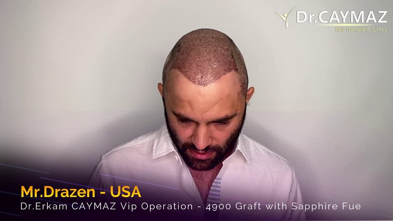Mr Drazen - USA  -  4900 Graft | Hair Transplant in Turkey Istanbul | Sapphire Fue