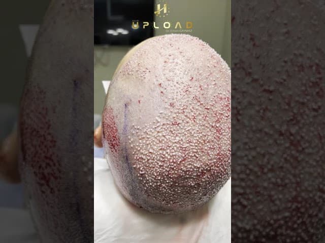 Hair Implantation Turkey