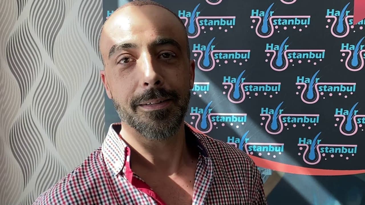 Mr Alexandros - Italy - 5200 Graft | Hair Transplant - Sapphire Fue Technique - Dr. Erkam