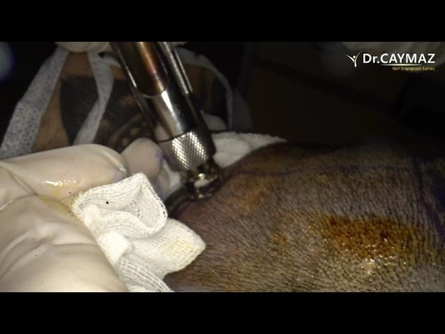 Painless Anesthesia Device