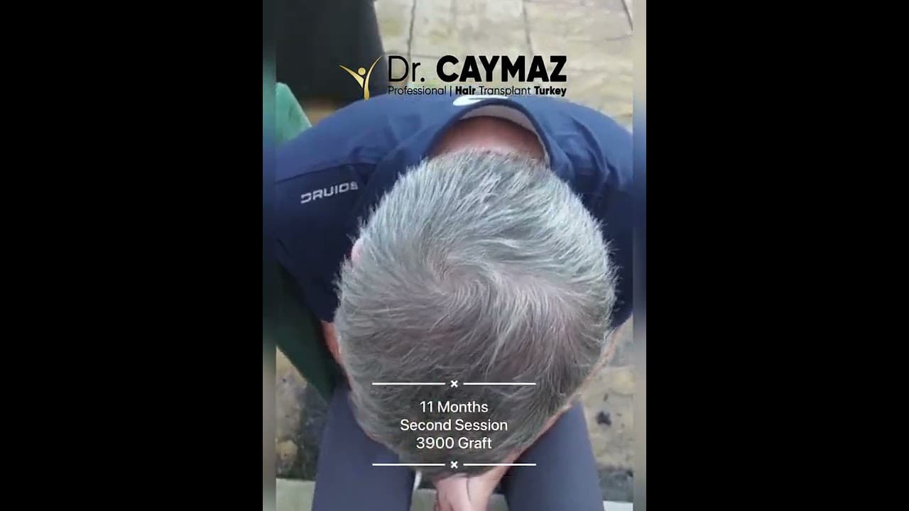 Hair Restoration - 3900 Graft - 11 Months - Second Session Result