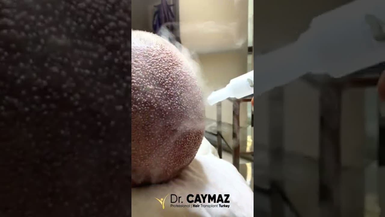 Hair Transplantation in Istanbul