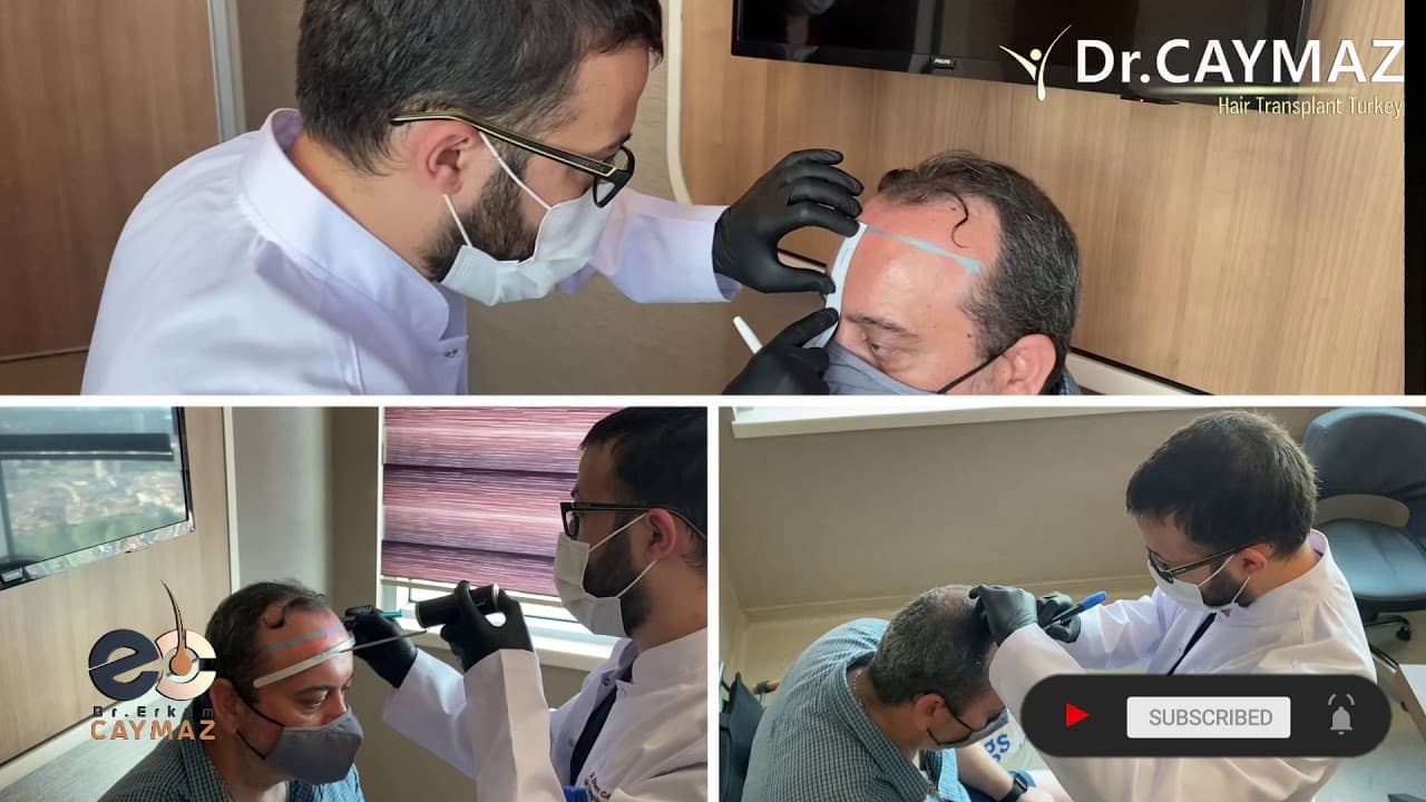 Consultation Hair Line Design Implantaton with Dr.Erkam Caymaz
