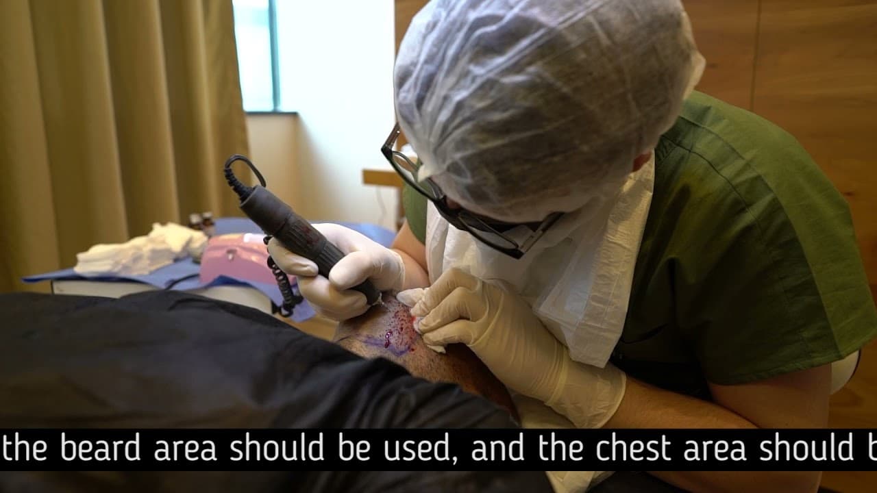 What is the Best Donor Areas for Hair Transplantation?