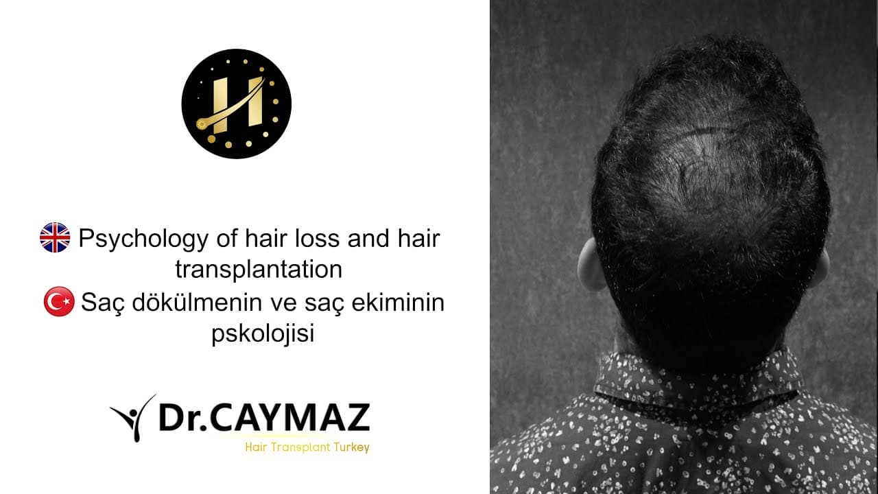 Psychology of hair loss and hair transplantation