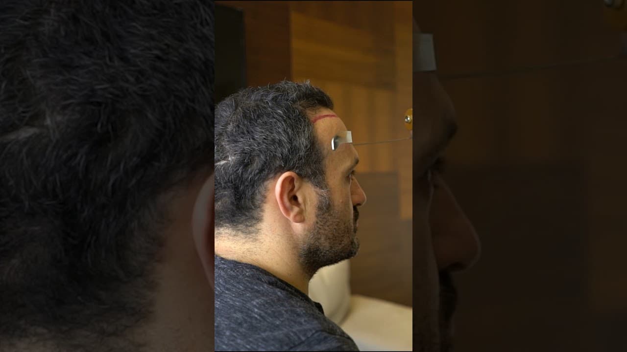 Hair Transplant in Turkey