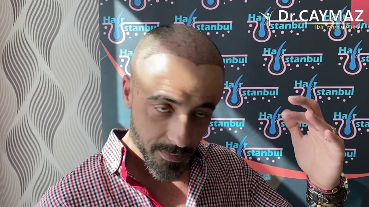 Mr Alexandros from Italy - 5200 Graft Implanted | Hair Transplant  in Turkey Istanbul | Fue