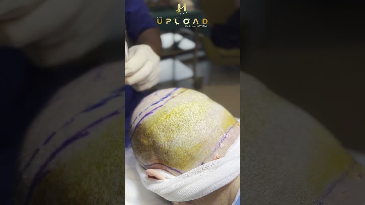 Needleless Anesthesia