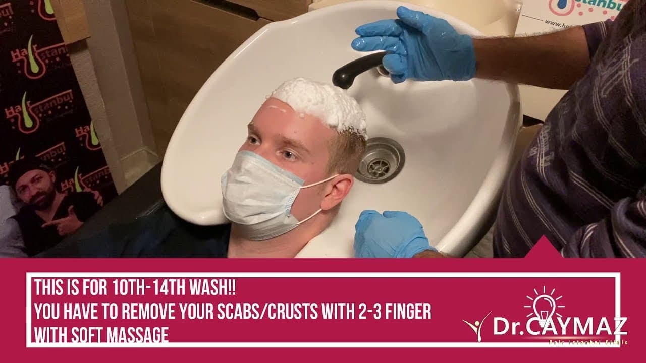 10th Hair Wash After Hair Transplantation / Remove Scabs