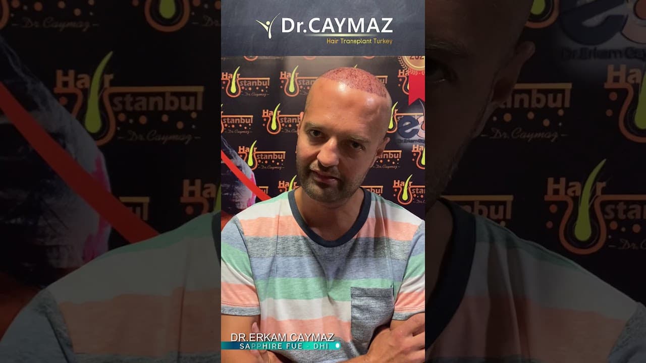 Mr Vedad aus Deutschland - 4000 Graft | Haartransplantation Bewertung