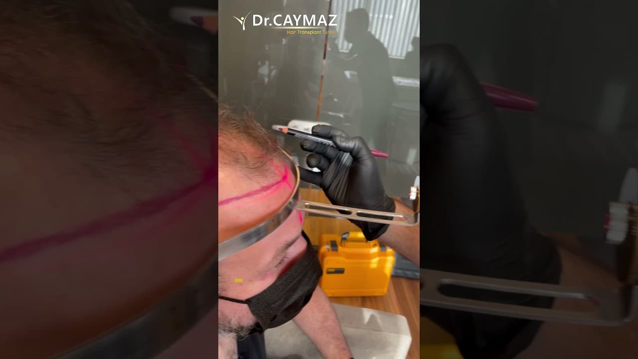 Hair Line Design with Laser by Medical Doctor