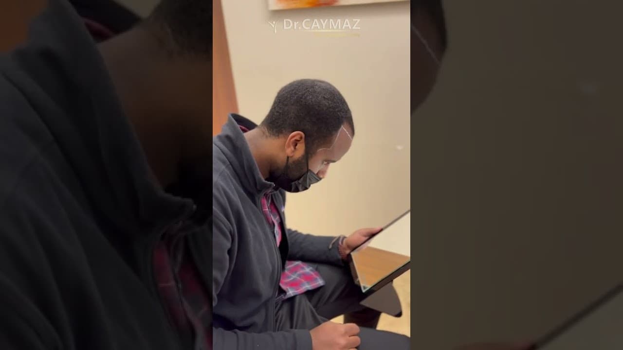 Dr.Caymaz afro hairline Planning