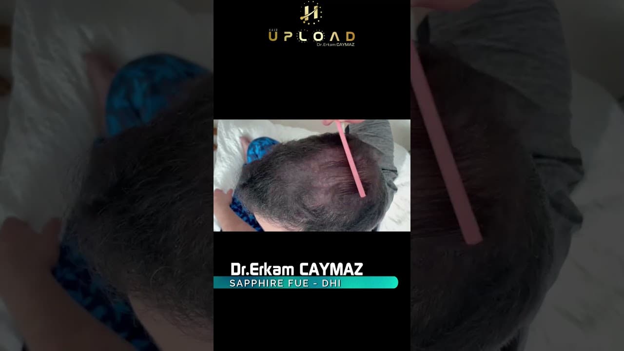 Hair Implantation and Beard Fixing