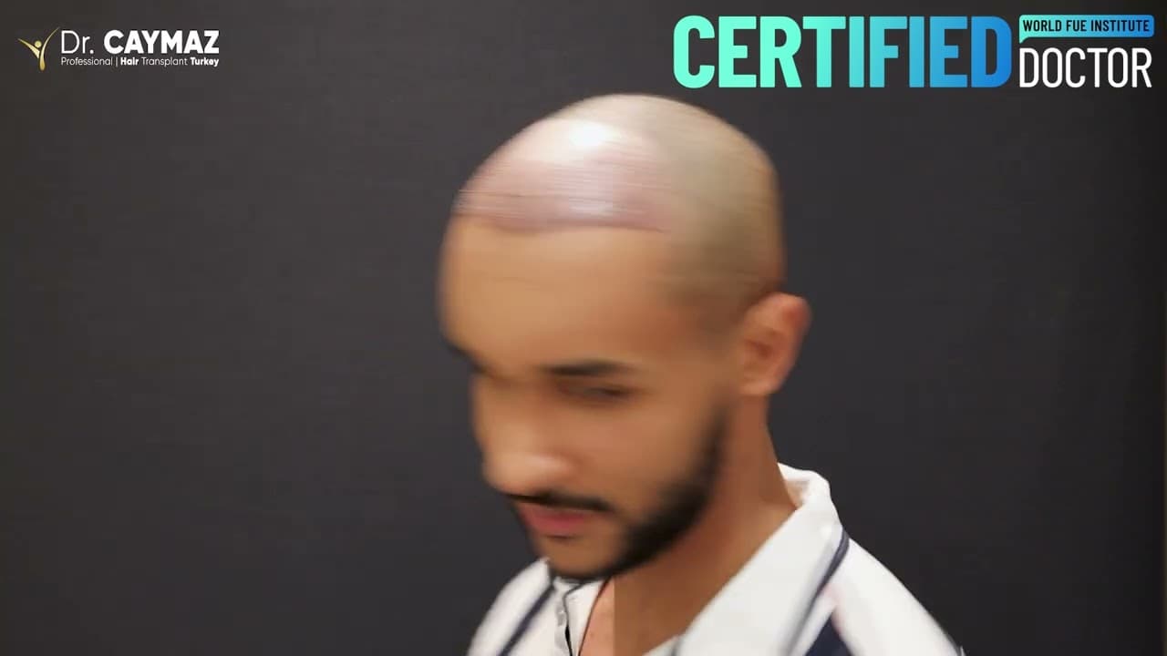 Taha Mohamed - USA - 2700 Graft - Afro American Hair Transplant Review - Sapphire FUE