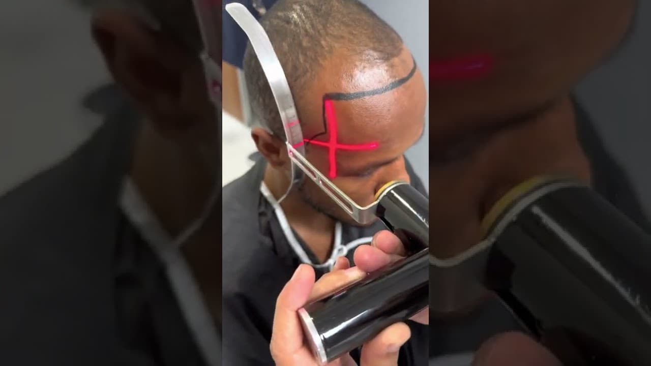 Hair Transplant Consultation by Doctor