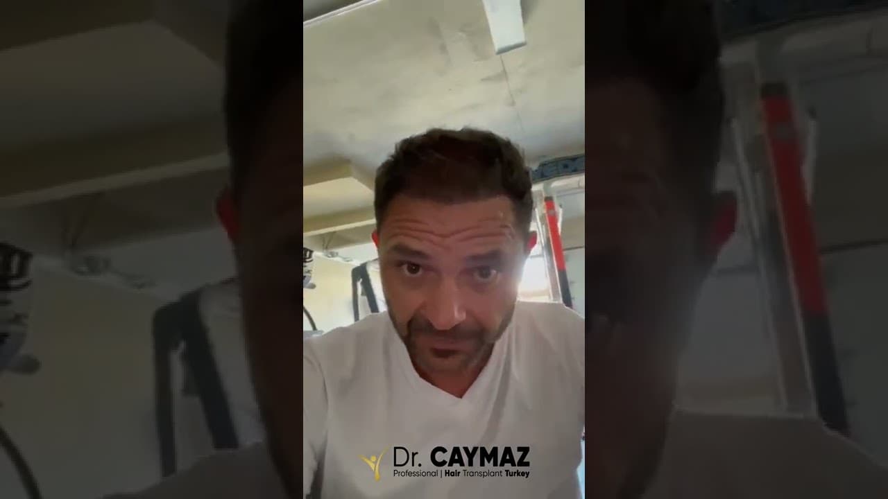 Mr Elvir / 5250 Hair Graft / Hair Transplantation by Dr Erkam CAYMAZ / 7 Months Result