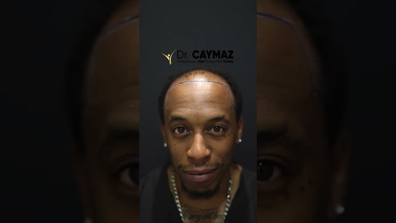 M Lee 4500 Graft 6,5 Months - Dr. Caymaz